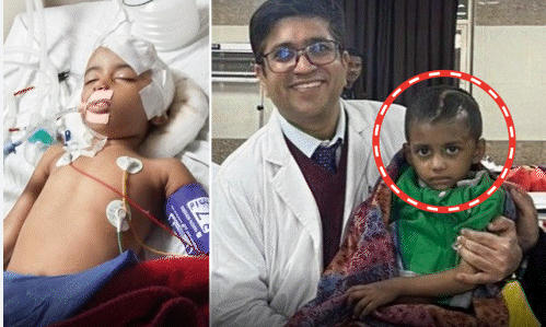 लखनऊ: बच्ची के सिर में घूम रही बुलेट निकाली गई, KGMU में 4.5 घंटे सर्जरी