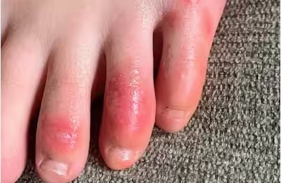 Ungli Me Khujli Ho To Kya Kare: